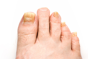 Fungal toenails treatment in the Boulder County, CO: Lafayette (Boulder, Louisville, Superior, Erie, Gunbarrel, Broomfield, Longmont) and Weld County, CO: Firestone, Frederick, Wattenburg, as well as Adams County, CO: Brighton, Northglenn areas