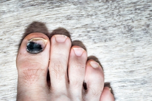Causes and Symptoms of Bruised Toenails