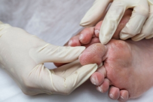 The Importance of Diabetic Foot Exams