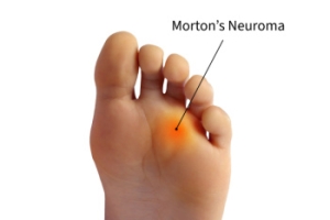 Is It Morton’s Neuroma?